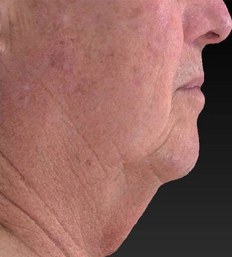 Ultraslim Facial Treatment