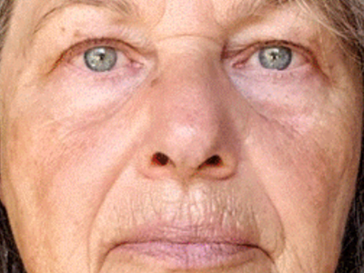 after advatx treatment results