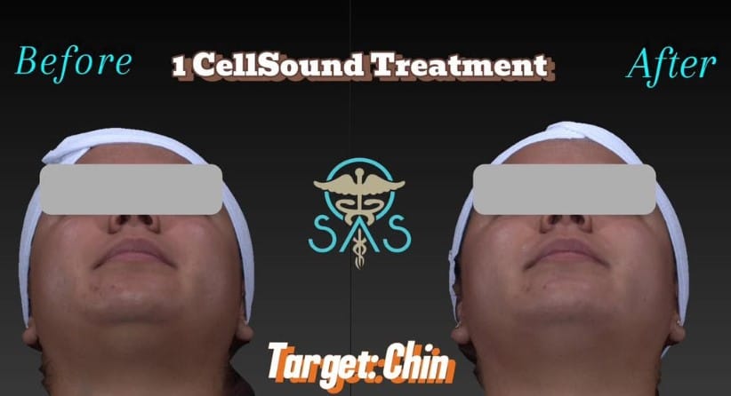 double chin reductiion with cellsound in mokena il
