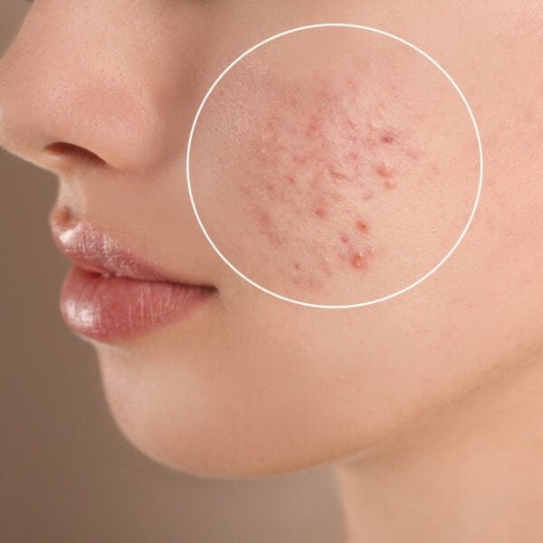 acne scar treatment mokena