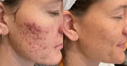 acne treatments in Mokena, IL