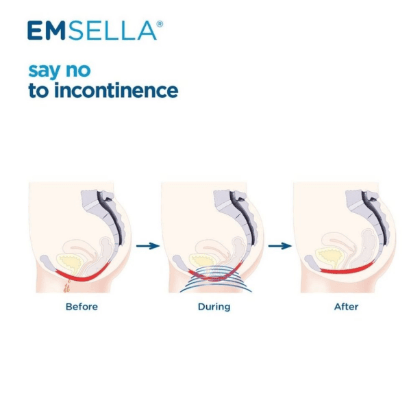 Pelvic Floor Strengthening treatment in Mokena, IL