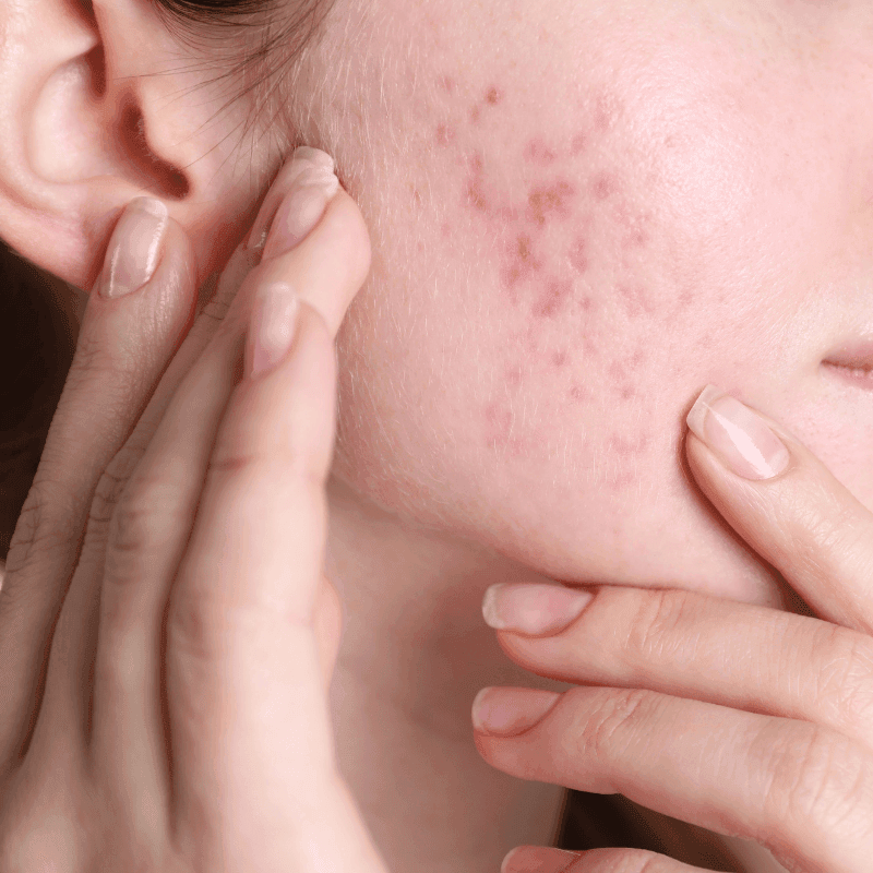 acne treatments in Mokena, IL