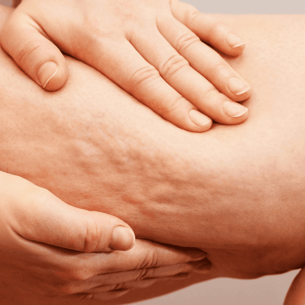cellulite reduction in Mokena, IL