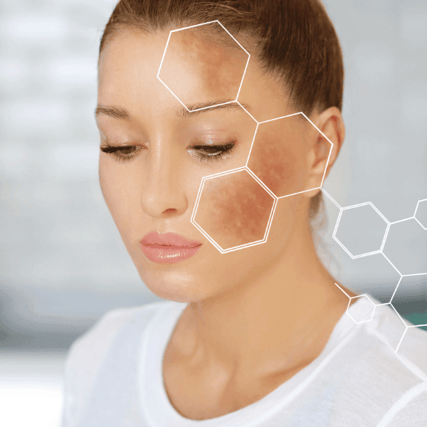 melasma & skin pigmentation in Mokena, IL