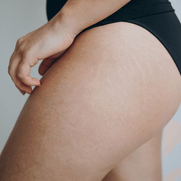 stretchmark treatment in Mokena, IL