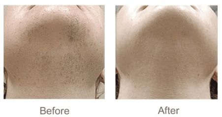 Laser Hair Removal in Mokena