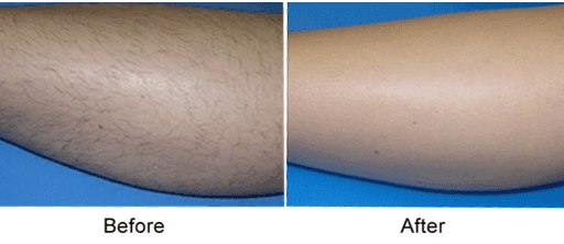 Laser Hair Removal in Mokena