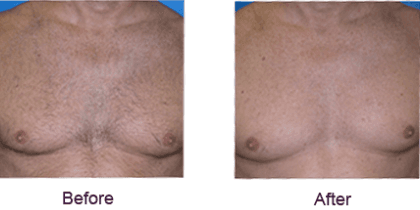 Laser Hair Removal in Mokena