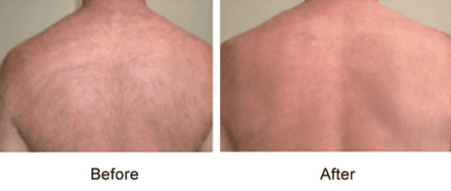 Laser Hair Removal in Mokena