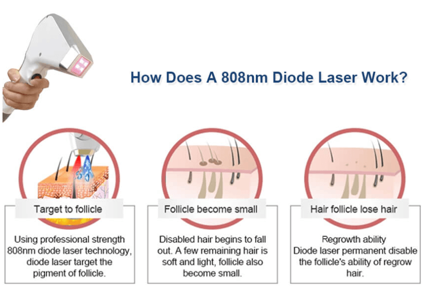 Laser Hair Removal in Mokena Laser Hair Removal in Mokena
