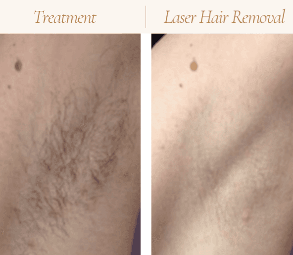 Laser Hair Removal in Mokena