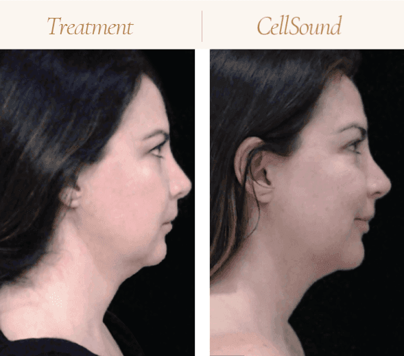 double chin reduction in Mokena