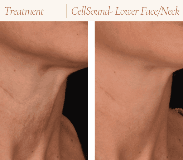 double chin reduction in Mokena