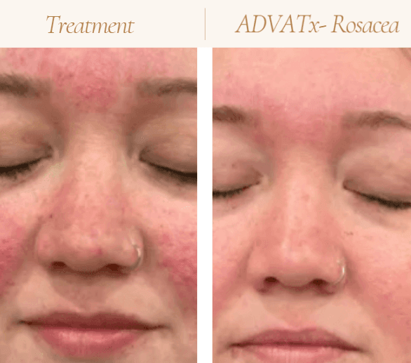 Acne Treatment in Mokena