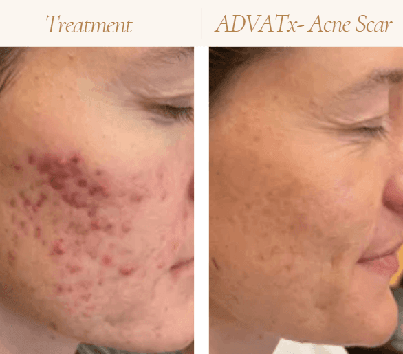 Acne Treatment in Mokena