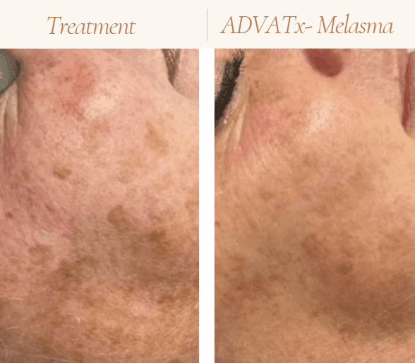 Acne Treatment in Mokena