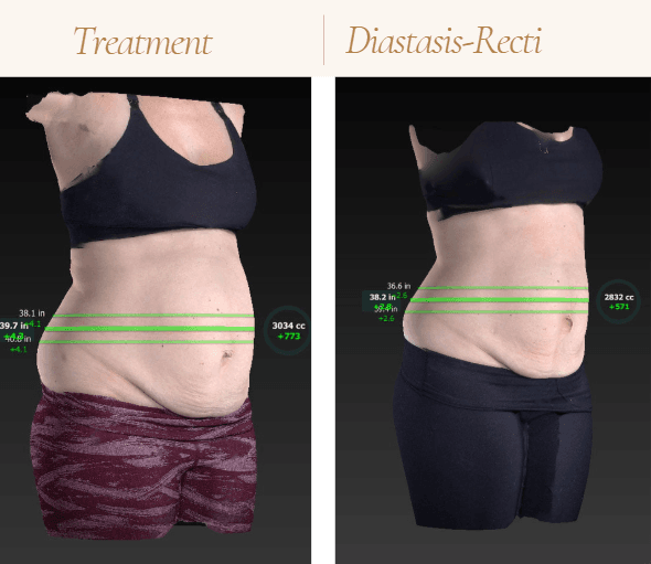 Reduce stubborn fat, smooth contours, and support natural weight loss
