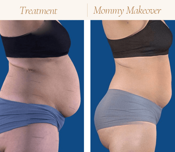 Reduce stubborn fat, smooth contours, and support natural weight loss