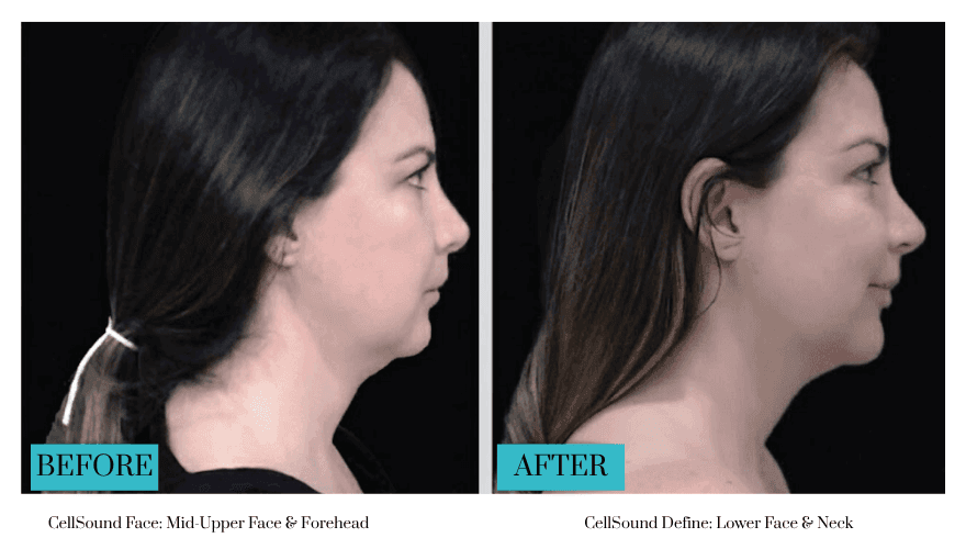 cell sound face treatment cell sound face treatment
