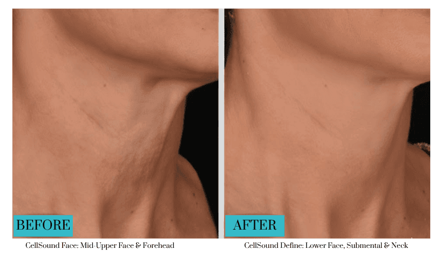 cell sound neck treatment cell sound neck treatment