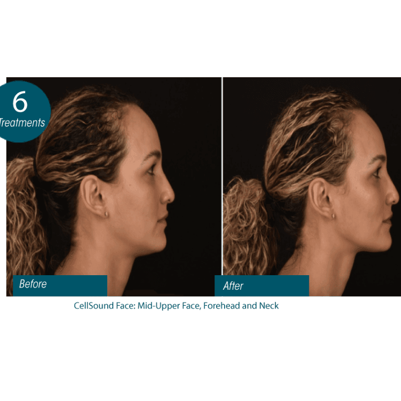 double chin reduction in Mokena