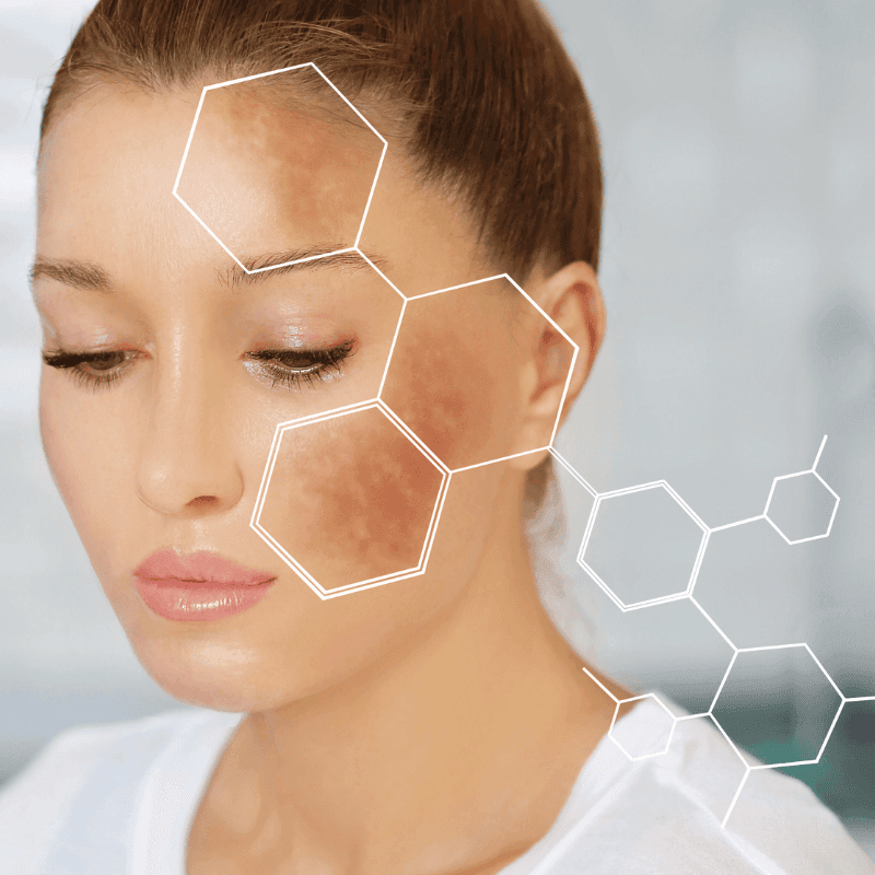 melasma treatment in mokena melasma treatment in mokena