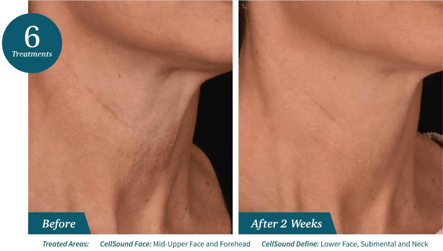 skin tightening results double chin reduction in Mokena