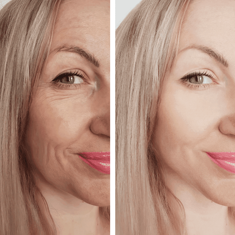 wrinkles treatment before and after