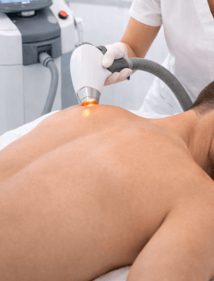 Laser hair removal mens back Laser hair removal mens back